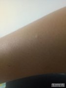 什么是后颈痛？
